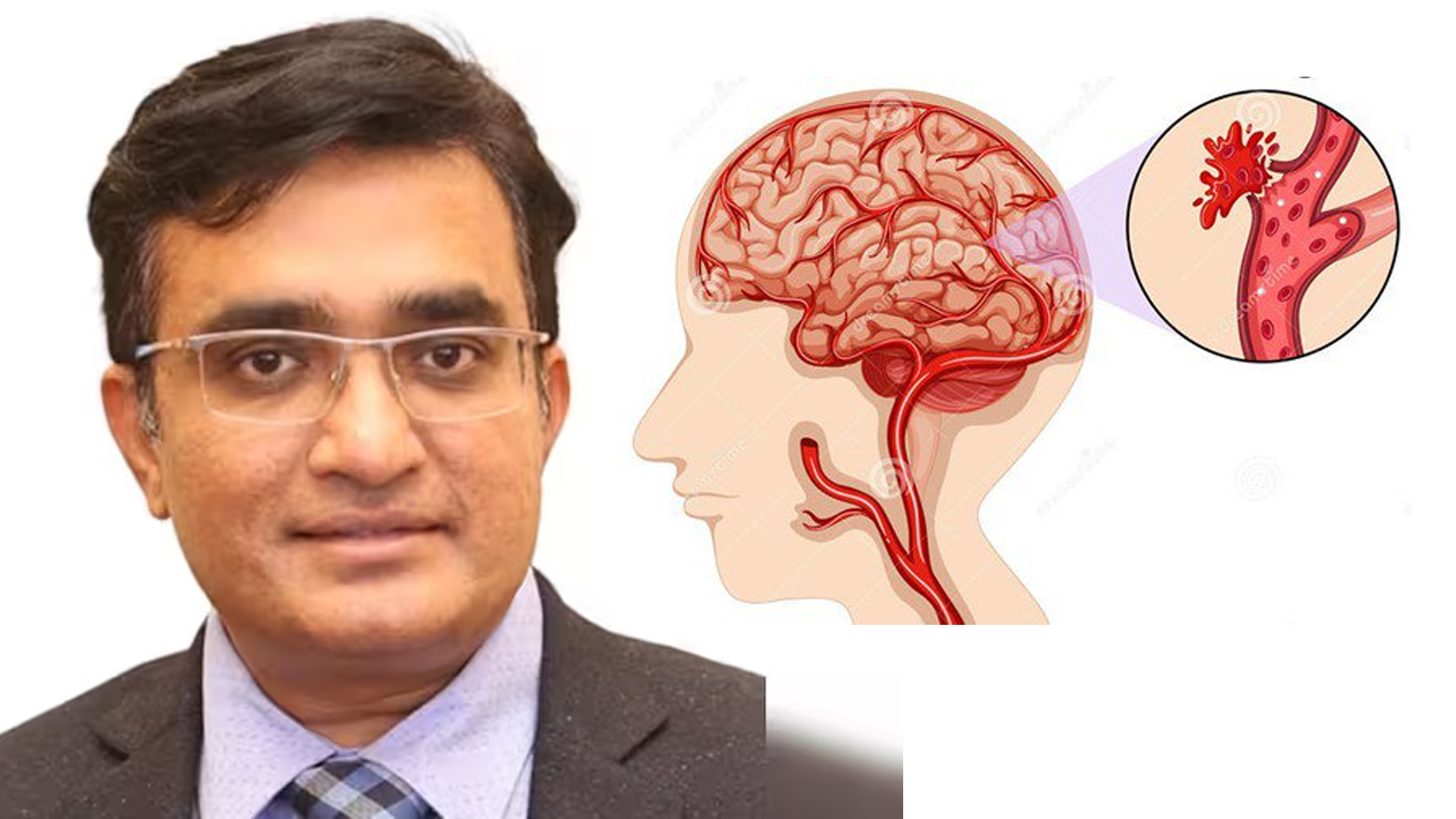 Brain Hemorrhage से 49 बरस के वाघ बकरी के कार्यकारी निदेशक देसाई का निधन, कितना जानते हैं आप ब्रेन हैमरेज के बारे में, Pehla Panna